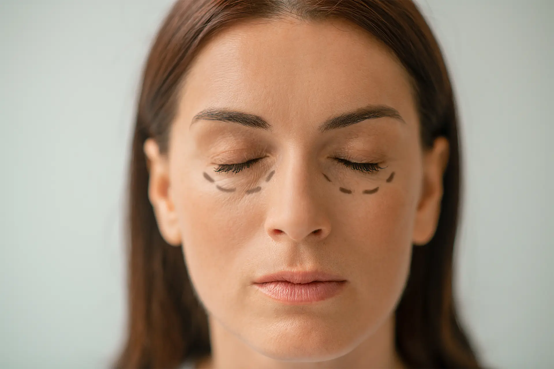 Göz Altı Işık Dolgusu