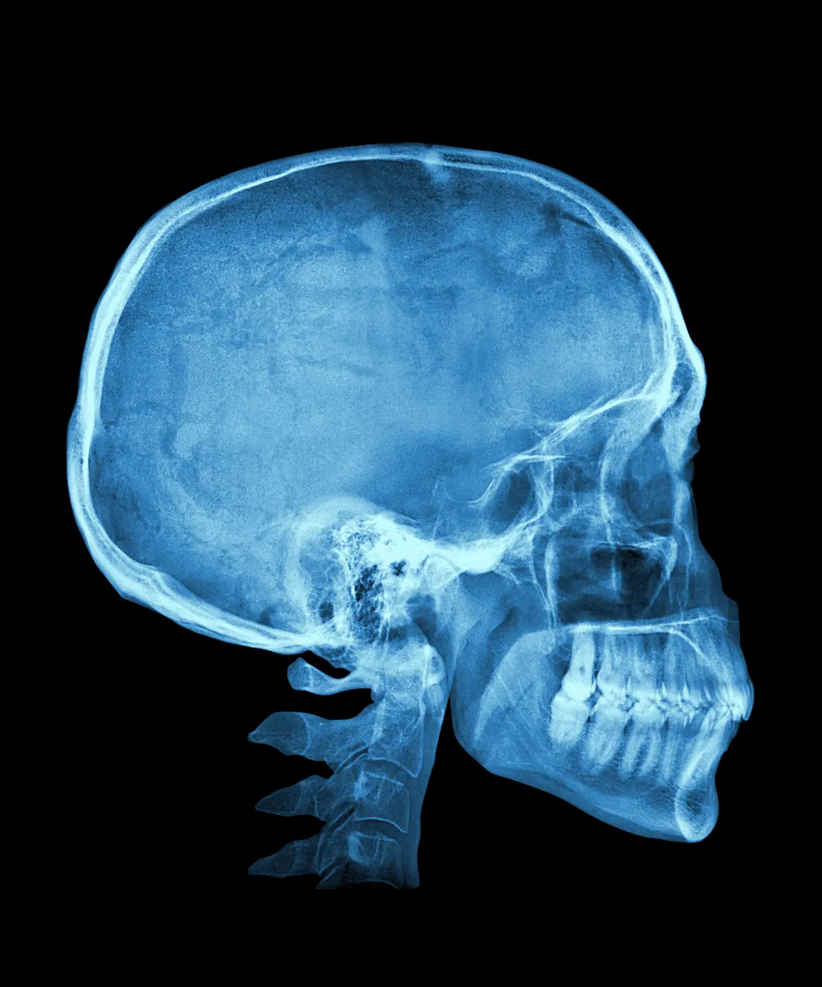 Yüz Kemik Kırıkları Estetiği Nasıl Yapılır?