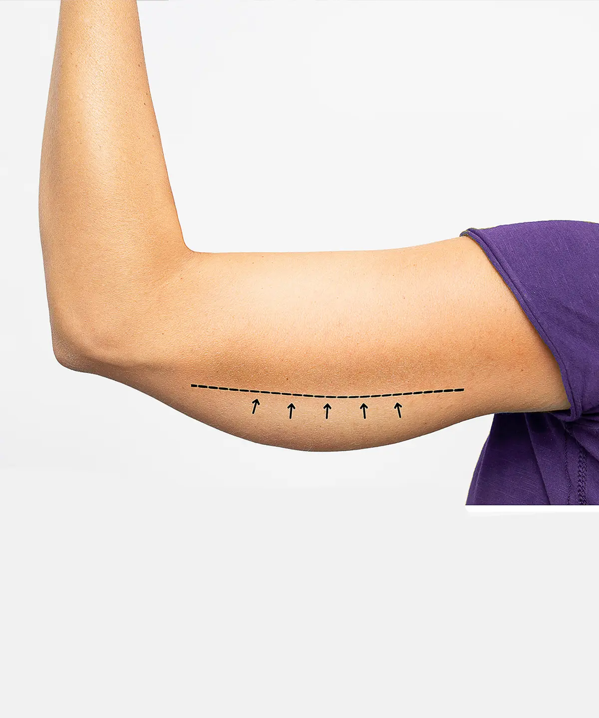 Ameliyatsız Kol Germe Nedir?