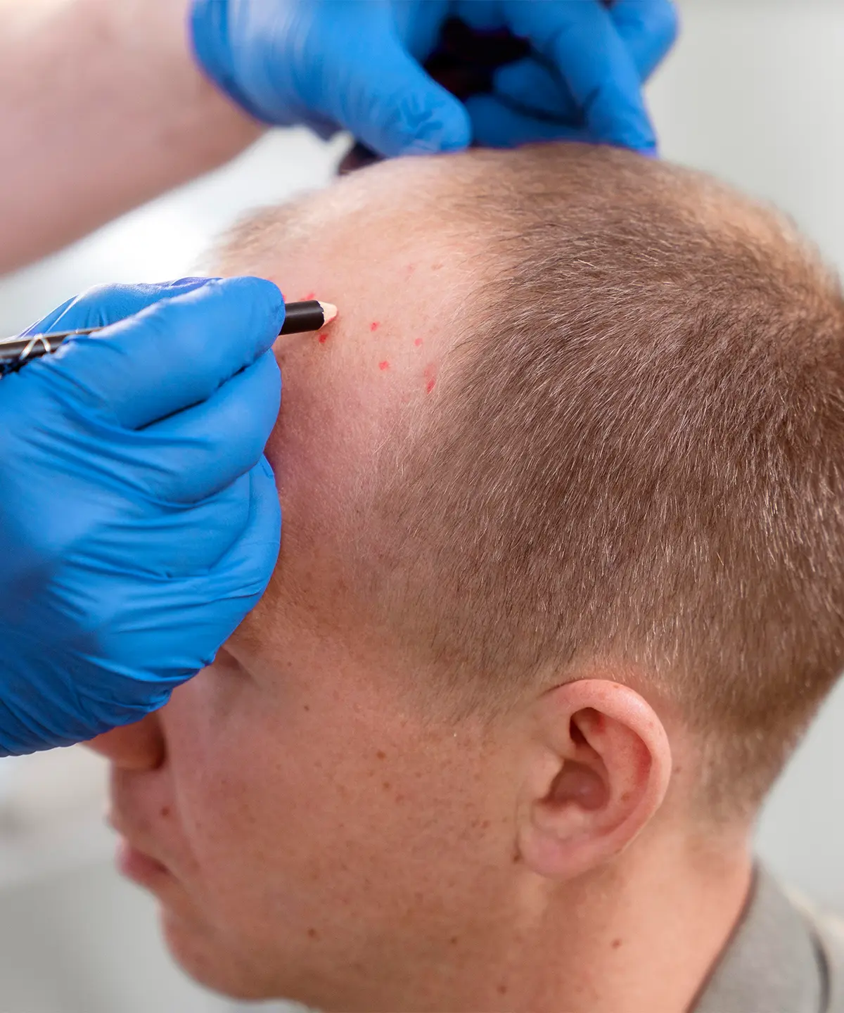 Saç Ekimi Sonrası Yapılması Gerekenler