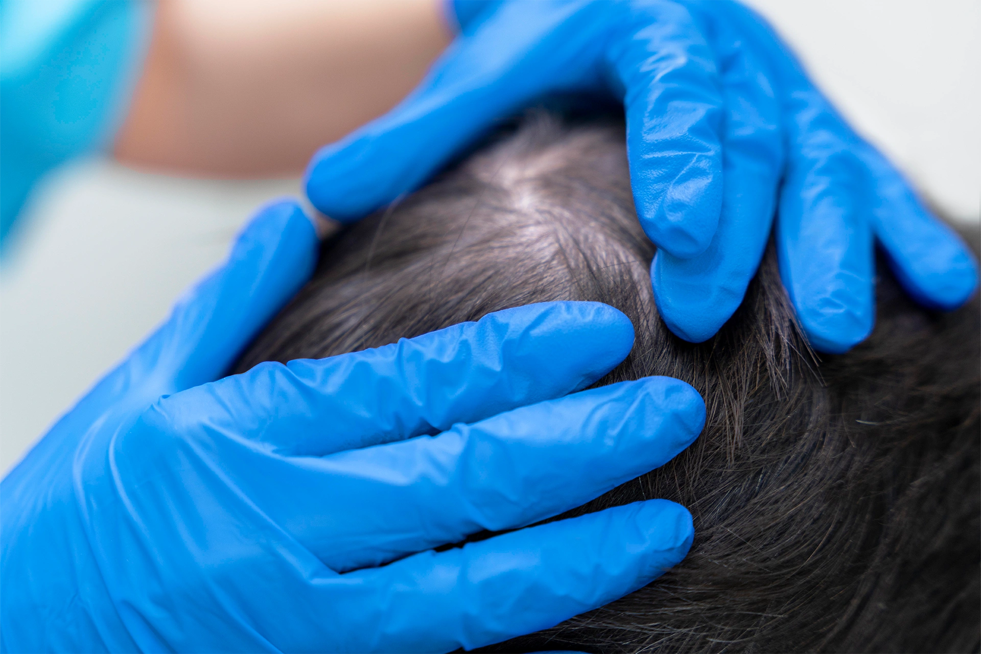 Saç Kök Hücre Tedavisi