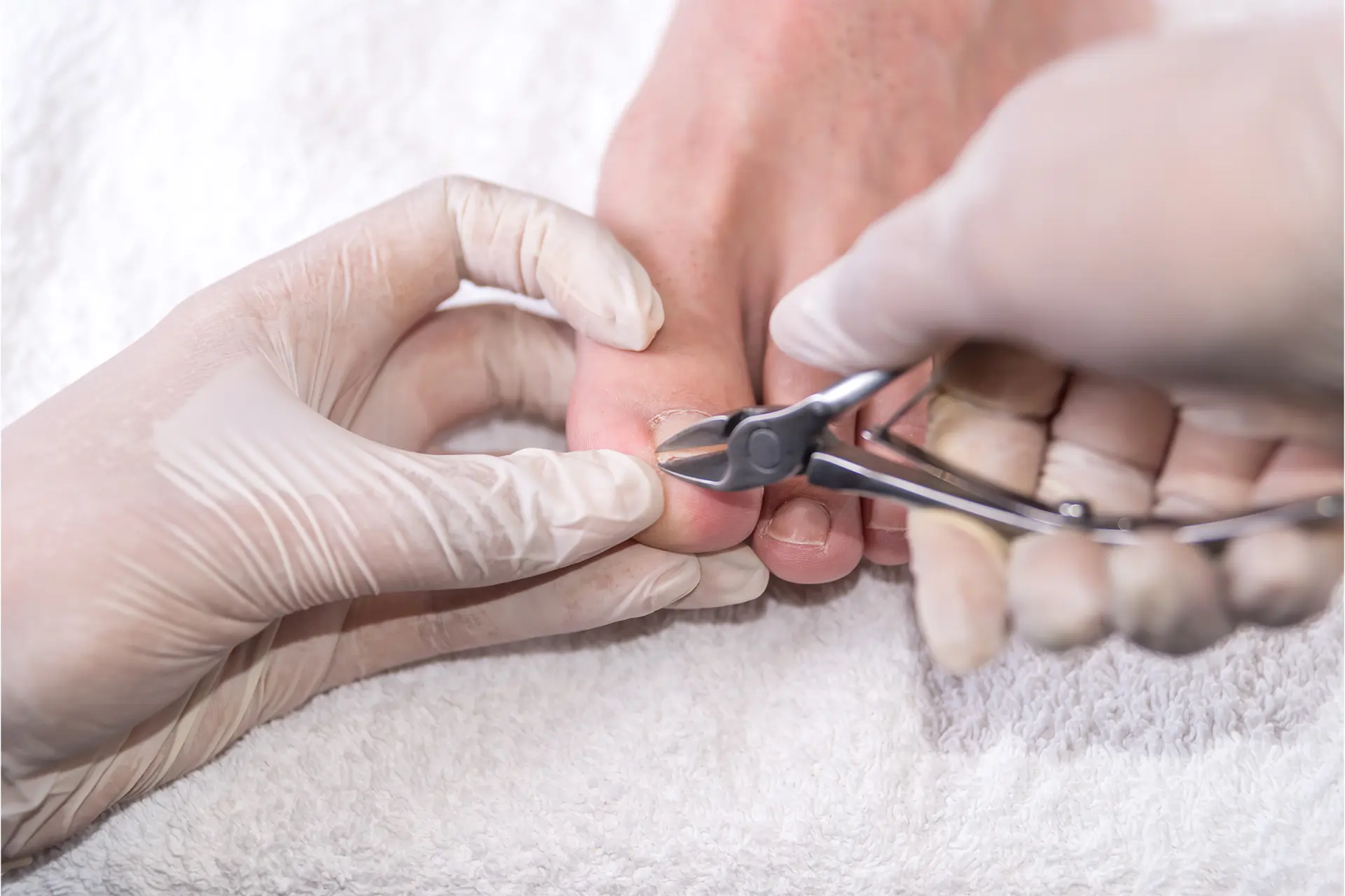 Tırnak Batması Tedavisi