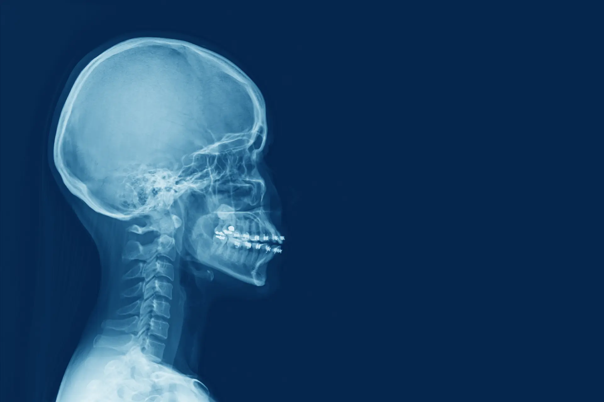 Yüz Kemik Kırıkları Estetiği